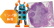 リンパ節転移スクリーニング
